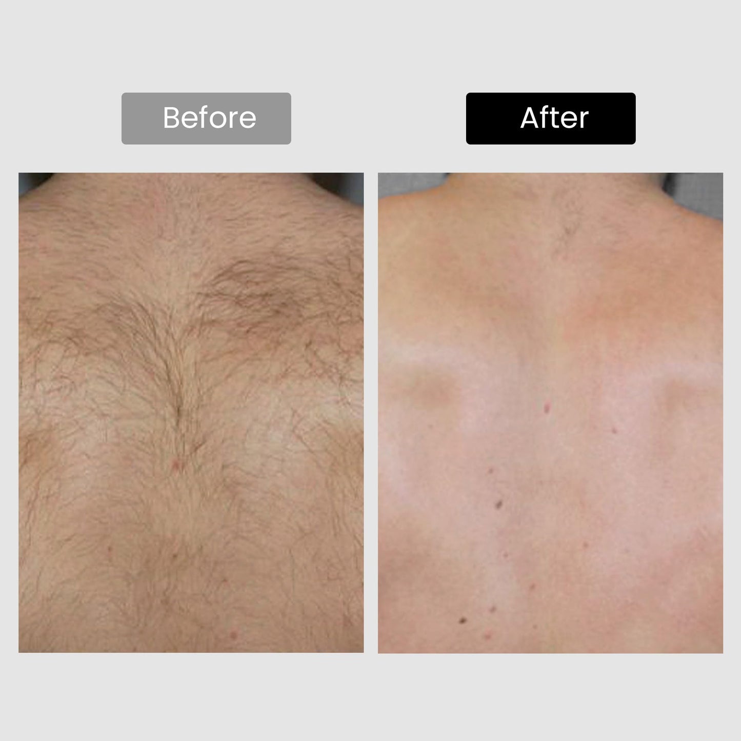 Diode Laser Hair Removal, Hair Removal Device for Skin Tone 1-5, Permanent Reduction in Hair Regrowth, Home-use Wide-Angle 810nm Laser Hair Removal Device