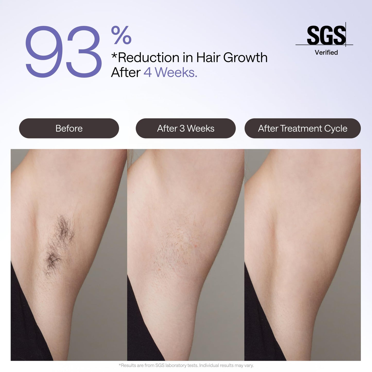 Ulike Laser Hair Removal Device Air 4 Ipl Gift for Women and Men, Ice Cool and Permanent Hair Reduction for Nearly Painless, USHR Mode Hair Removal in 10mins from Home
