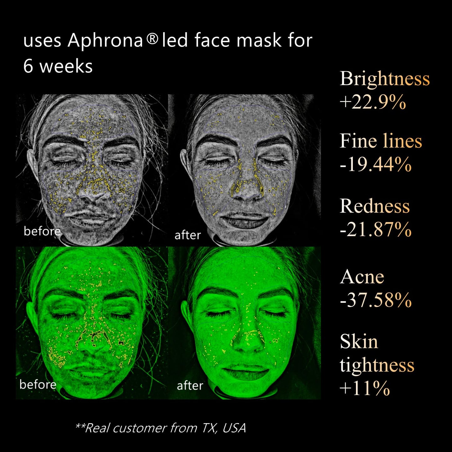 Aphrona Halo Led Face Mask Light Therapy, Led Light Therapy Facial and Neck Skin Care Mask, Blue Light Red Light for Acne Wrinkle Reduce