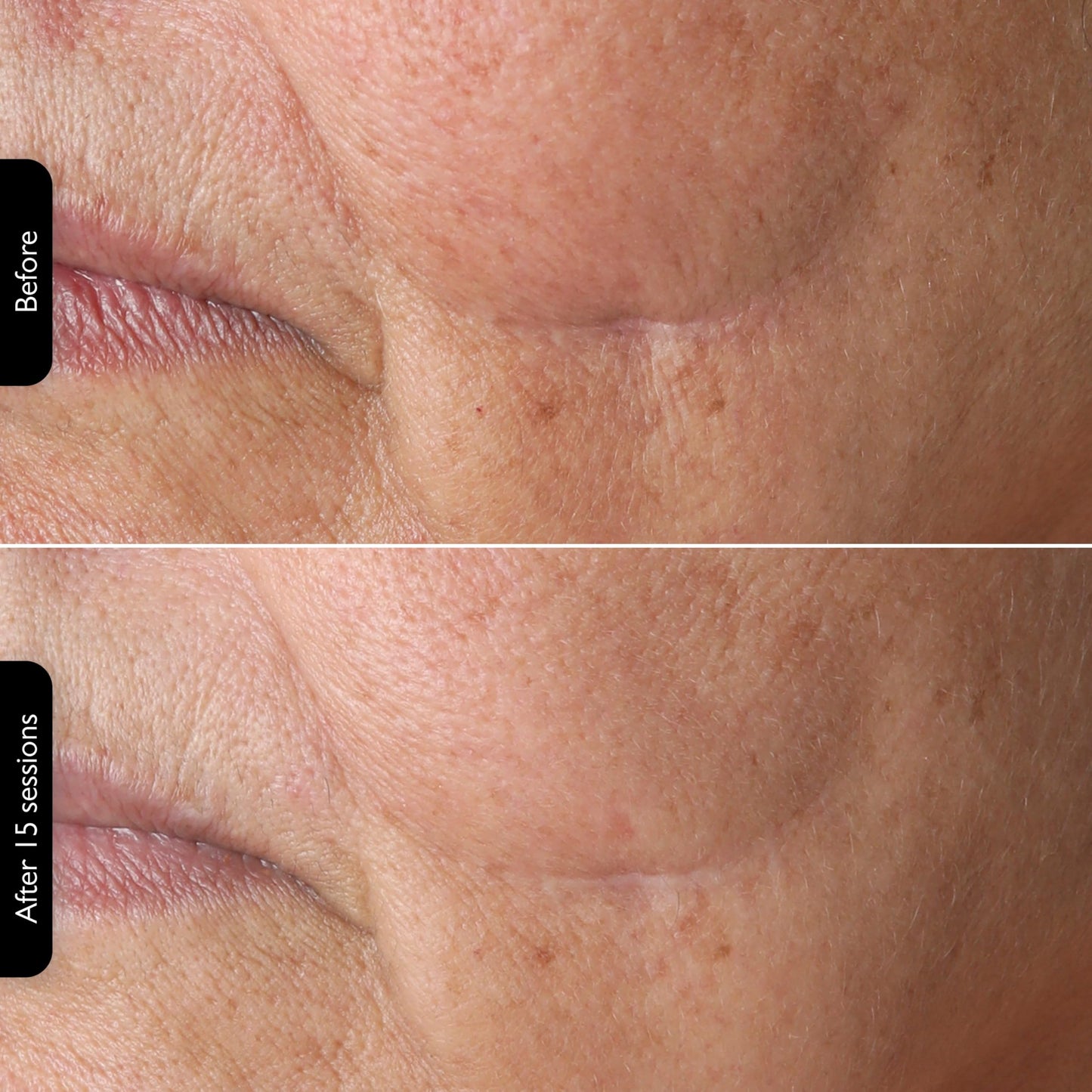 Silk’n Titan Multiplatform At-Home 3-in-1 Radio Frequency Skin Tightening Device for Face and Neck, Combines RF with Low-Level Laser Therapy & Red Light Therapy, with Thermal Sensor, Cordless