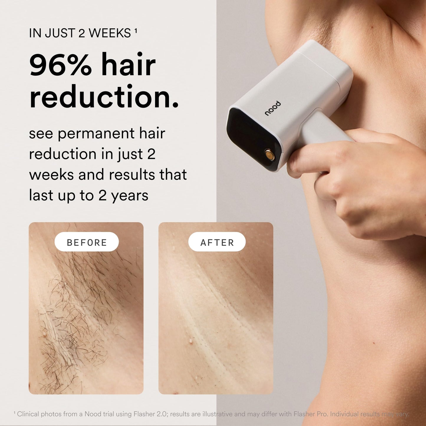 Nood™ NEW Flasher Pro Kit — IPL Laser Hair Removal Device for Women & Men + Refillable 5-Blade Shaving Razor Kit + Exfoliating Buff Bar + Hydrating Shave Lube + After Shave Serum — Gloss White